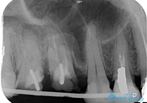 [縁下カリエス] 多発した深い虫歯の治療の治療前
