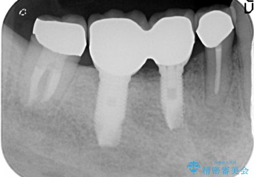 [咬合性外傷] インプラント補綴で残った歯を守る治療の治療後