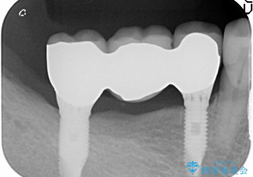 [遊離歯肉移植] インプラント周囲に強い歯ぐきを移植の治療後