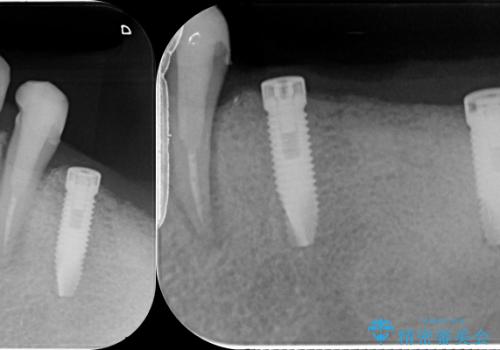 [咬合性外傷] インプラントで歯を残す治療の治療中