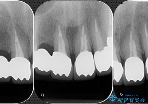 [前歯部ジルコニアブリッジ] 前歯の治療で見た目を美しくの治療後
