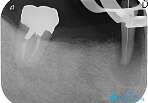 [咬合性外傷] インプラント補綴で残った歯を守る治療の治療前
