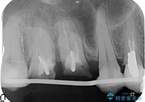 [縁下カリエス] 多発した深い虫歯の治療の治療前