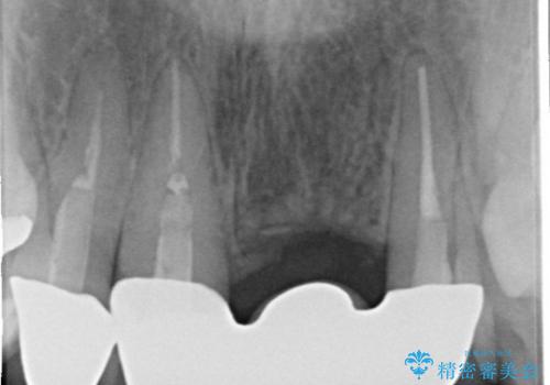 [前歯の審美・機能回復]  前歯を1本失った場合 3つの治療方法の治療後
