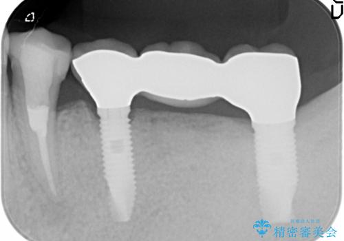 [咬合性外傷] インプラントで歯を残す治療の症例 治療後