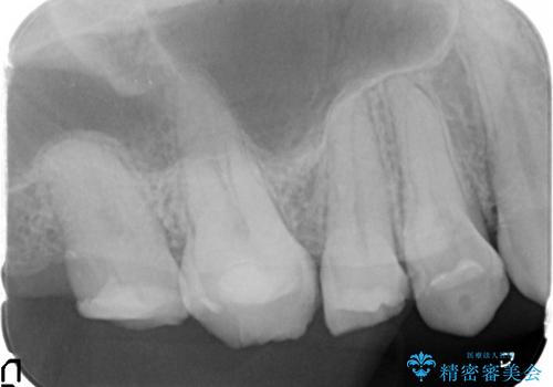 [歯周外科] 歯ぐきの状態を整えてからのセラミック治療の治療前