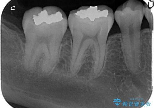 [セラミックインレー]  銀歯の下の虫歯再発 審美修復治療の治療前
