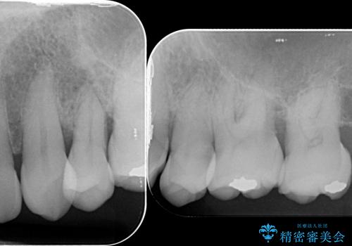 [歯周病治療③] メタルボンドブリッジ補綴で咬合機能の回復の治療前