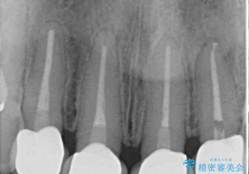 総合歯科診療　矯正希望で通院したら前歯がクラウンになっていた方の再治療の治療後