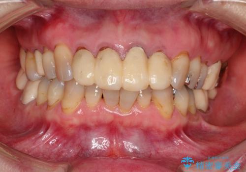 大学病院での治療に不満　仮歯はもっと綺麗にして欲しいの症例 治療前