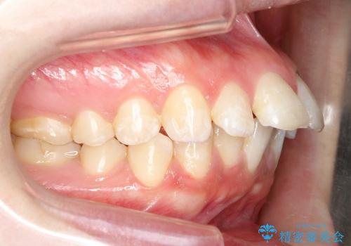 20代女性　インビザラインによる出っ歯の矯正の治療前