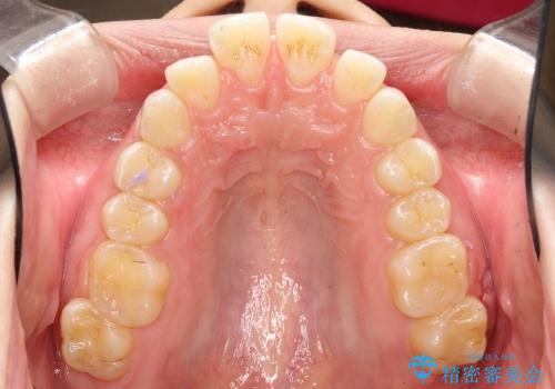 20代女性　インビザラインによる出っ歯の矯正の治療前