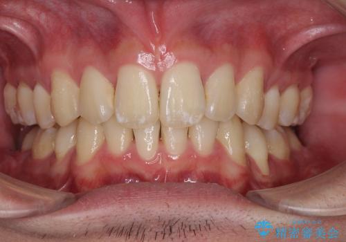 20代男性　ハーフリンガルによる抜歯矯正の症例 治療後
