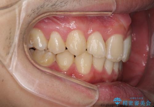 20代男性　ハーフリンガルによる抜歯矯正の治療後