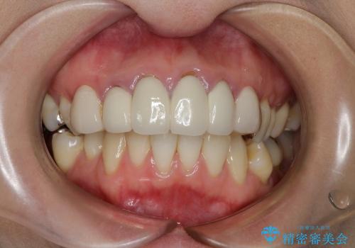 総合歯科診療　矯正希望で通院したら前歯がクラウンになっていた方の再治療の症例 治療前