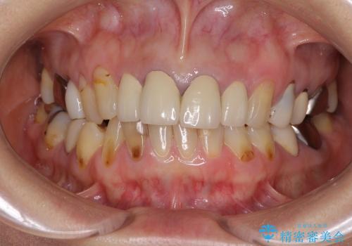 奥歯の審美治療　オールセラミッククラウンで白い歯にの治療前