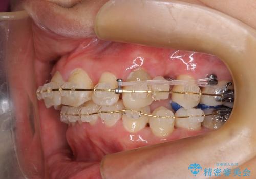 歯軸を改善したオールセラミックブリッジ治療の治療前