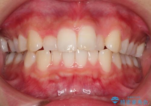 20代女性　非抜歯をオーソドックスなワイヤー矯正での治療前