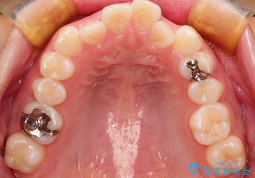 20代女性　非抜歯をオーソドックスなワイヤー矯正での治療前