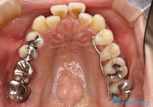 30代女性　前歯の前突感・ガタガタを改善　抜歯矯正の症例 治療前
