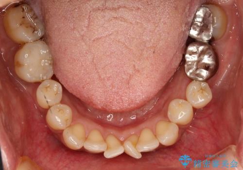 30代女性　前歯の前突感・ガタガタを改善　抜歯矯正の治療前