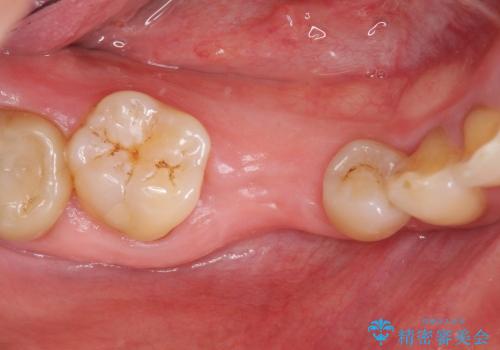 [乳歯の晩期残存]  歯周組織再生療法を併用したインプラント治療の治療前