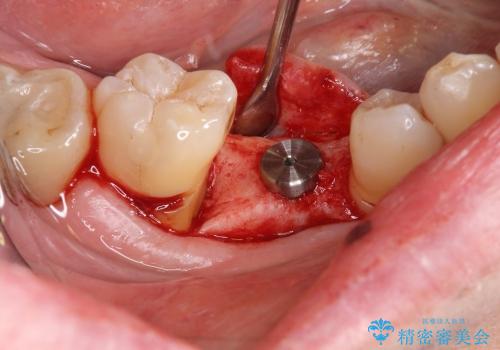 [乳歯の晩期残存]  歯周組織再生療法を併用したインプラント治療の治療中