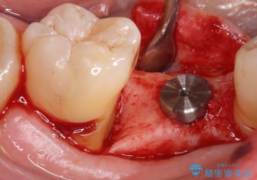 [乳歯の晩期残存]  歯周組織再生療法を併用したインプラント治療