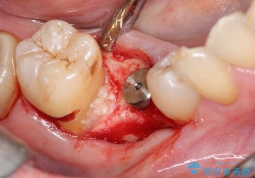 [乳歯の晩期残存]  歯周組織再生療法を併用したインプラント治療の治療中