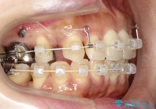 30代女性　前歯の前突感・ガタガタを改善　抜歯矯正の治療中