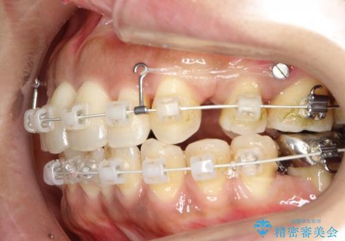 30代女性　前歯の前突感・ガタガタを改善　抜歯矯正の治療中