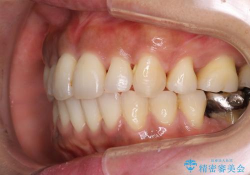 30代女性　前歯の前突感・ガタガタを改善　抜歯矯正の治療後