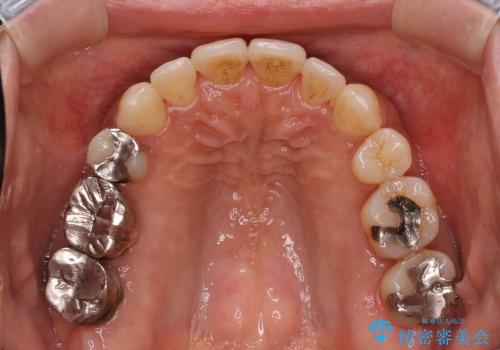 30代女性　前歯の前突感・ガタガタを改善　抜歯矯正の症例 治療後