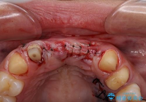 事故で抜けかけた歯　歯が溶けてしまった方のブリッジ治療の治療中