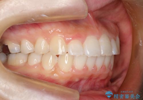20代女性　非抜歯をオーソドックスなワイヤー矯正での治療後