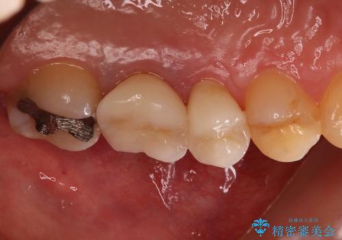 20代女性　骨レベルまで深い虫歯を保存するにはの症例 治療後