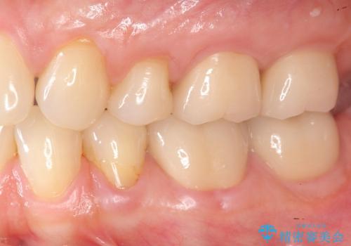 [知覚過敏]  歯ぐきが下がってしみる歯を歯肉移植で改善の治療後