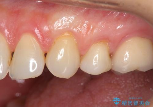 [知覚過敏]  歯ぐきが下がってしみる歯を歯肉移植で改善の症例 治療後