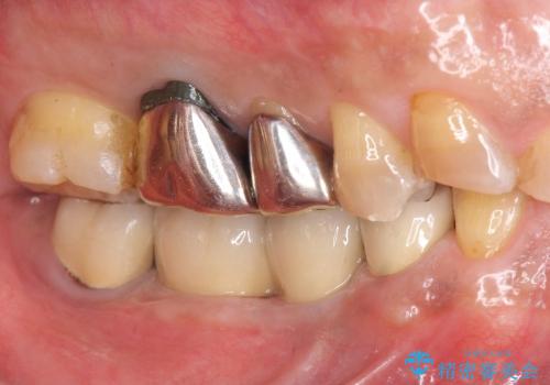 [咬合性外傷] インプラント補綴で残った歯を守る治療の治療後