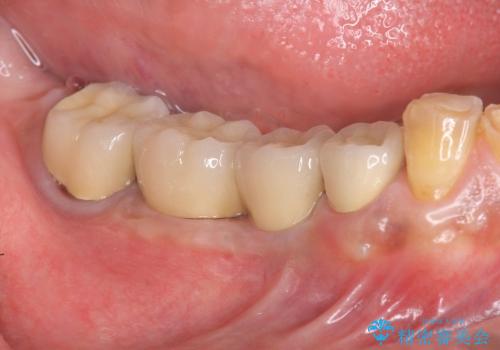 [咬合性外傷] インプラント補綴で残った歯を守る治療の症例 治療後