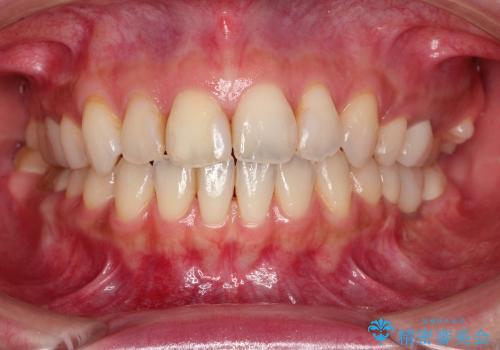 歯並びを整えたら、銀歯が気になってきた　矯正治療後の審美治療の症例 治療後