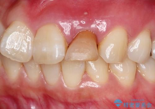 前歯がグラグラで残せない　上顎前歯ブリッジ治療の治療前
