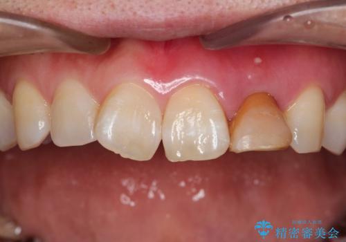 前歯がグラグラで残せない　上顎前歯ブリッジ治療の症例 治療前