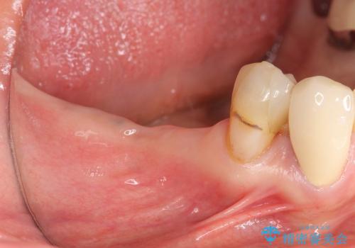 [遊離歯肉移植] インプラント周囲に強い歯ぐきを移植の治療前