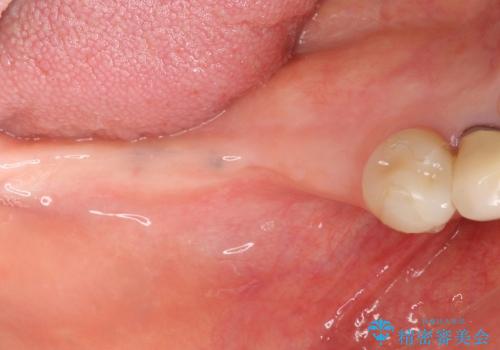 [遊離歯肉移植] インプラント周囲に強い歯ぐきを移植の治療前
