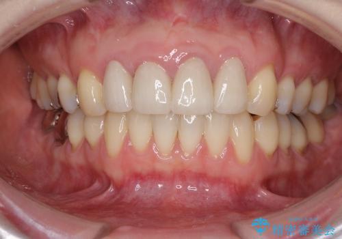 総合歯科診療　矯正希望で通院したら前歯がクラウンになっていた方の再治療の症例 治療後