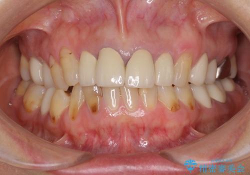 奥歯の審美治療　オールセラミッククラウンで白い歯にの治療後