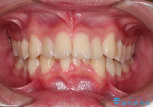 20代男性　ハーフリンガルによる抜歯矯正の症例 治療前