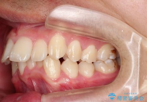 20代男性　ハーフリンガルによる抜歯矯正の治療前