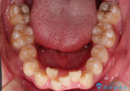 20代男性　ハーフリンガルによる抜歯矯正の治療前
